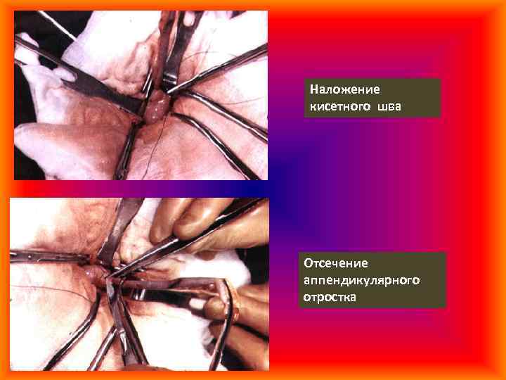 Наложение кисетного шва Отсечение аппендикулярного отростка 