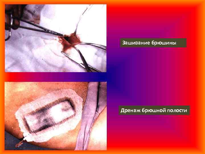 Зашивание брюшины Дренаж брюшной полости 