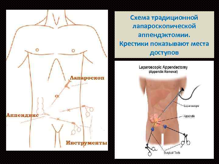 Аппендицит расположение схема