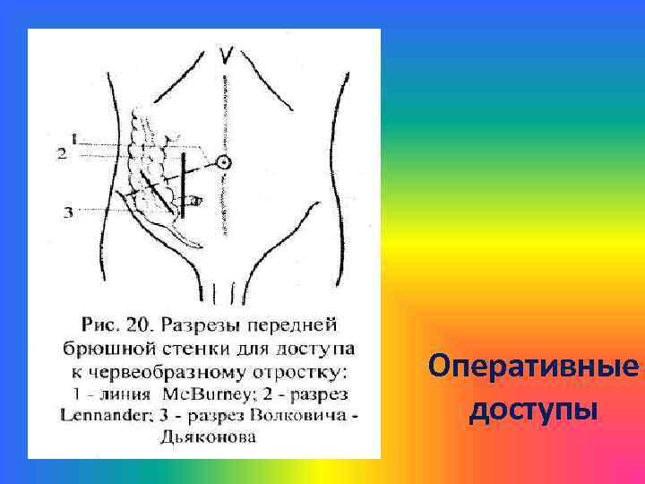 Точки аппендицита. Точка Мак Бурнея Волковича Дьяконова. Разрез Мак Бурнея Волковича Дьяконова. Параректальный разрез передней брюшной стенки. Аппендэктомия оперативный доступ.