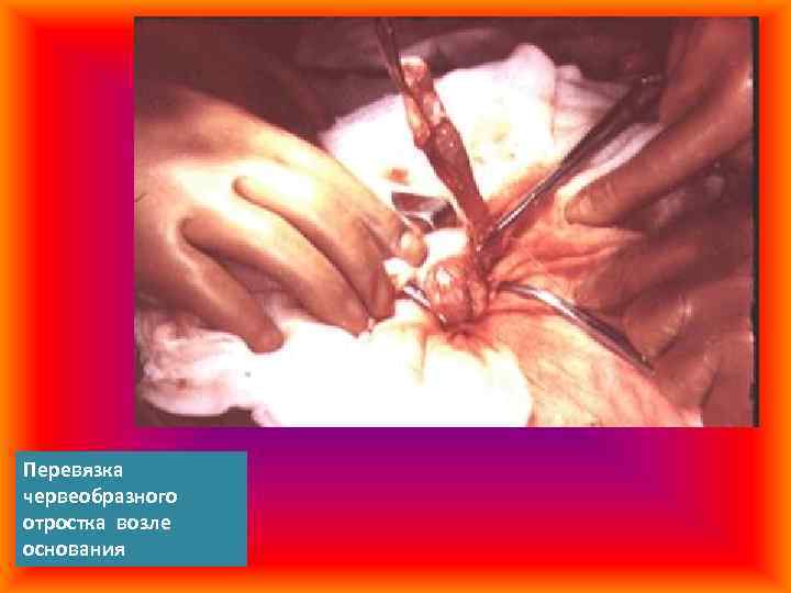 Перевязка червеобразного отростка возле основания 