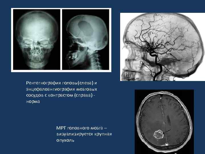 Рентегнография головы(слева) и энцефалоангиография мозговых сосудов с контрастом (справа) норма МРТ головного мозга –