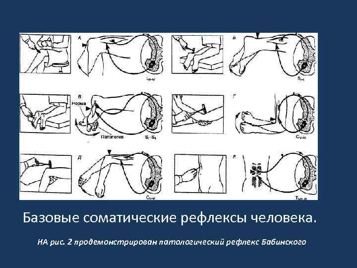 Базовые соматические рефлексы человека. НА рис. 2 продемонстрирован патологический рефлекс Бабинского 