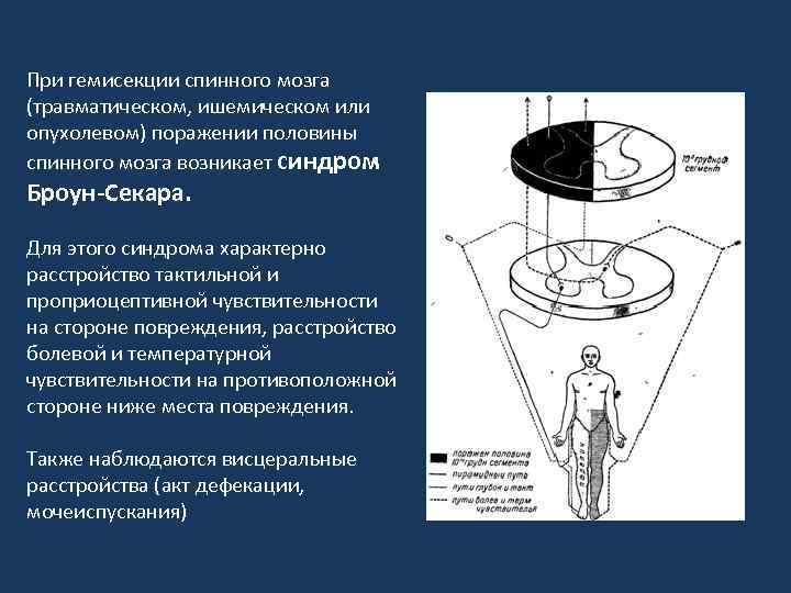 Синдром броун секара это