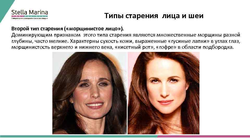 Типы старения лица и шеи Второй тип старения ( «морщинистое лицо» ). Доминирующим признаком