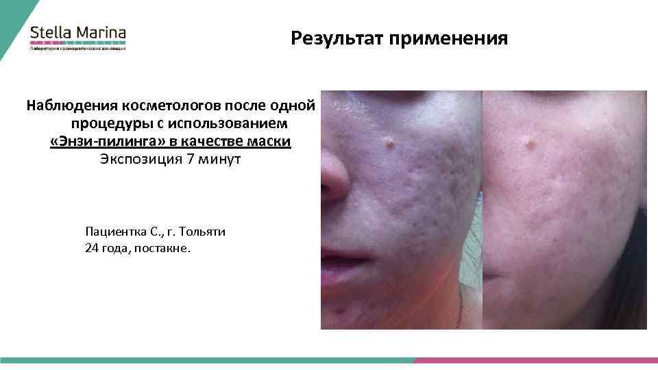 Результат применения Наблюдения косметологов после одной процедуры с использованием «Энзи-пилинга» в качестве маски Экспозиция
