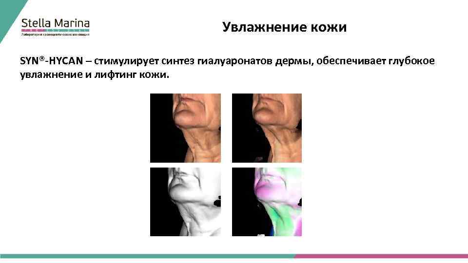 Увлажнение кожи SYN®-HYCAN – стимулирует синтез гиалуаронатов дермы, обеспечивает глубокое увлажнение и лифтинг кожи.