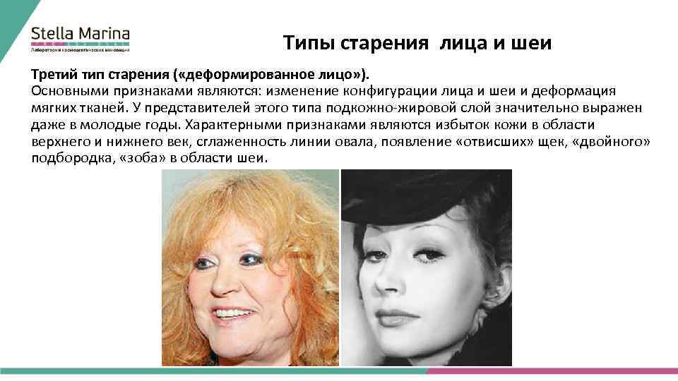 Типы старения лица и шеи Третий тип старения ( «деформированное лицо» ). Основными признаками