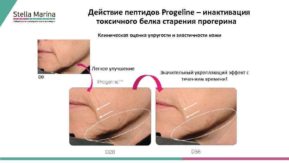 Действие пептидов Progeline – инактивация токсичного белка старения прогерина Клиническая оценка упругости и эластичности