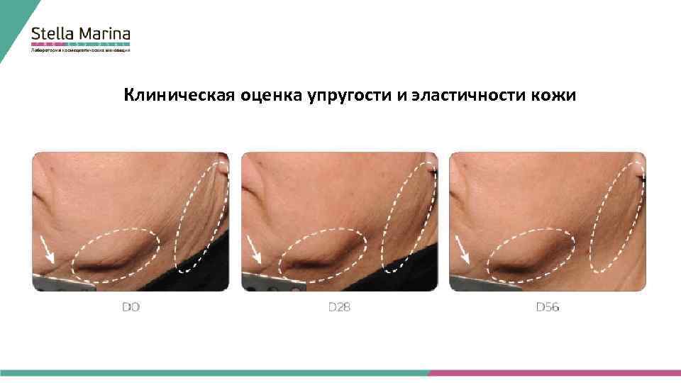 Клиническая оценка упругости и эластичности кожи 