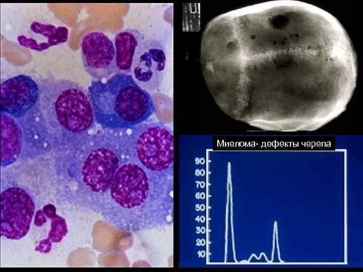 Миелома- дефекты черепа 