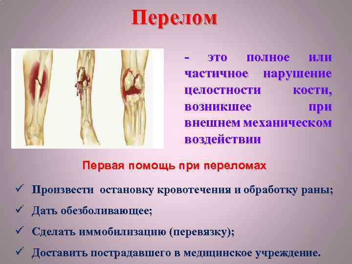 Перелом - это полное или частичное нарушение целостности кости, возникшее при внешнем механическом воздействии
