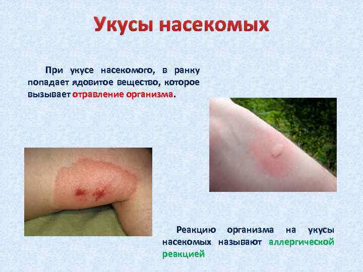 Укусы насекомых При укусе насекомого, в ранку попадает ядовитое вещество, которое вызывает отравление организма.