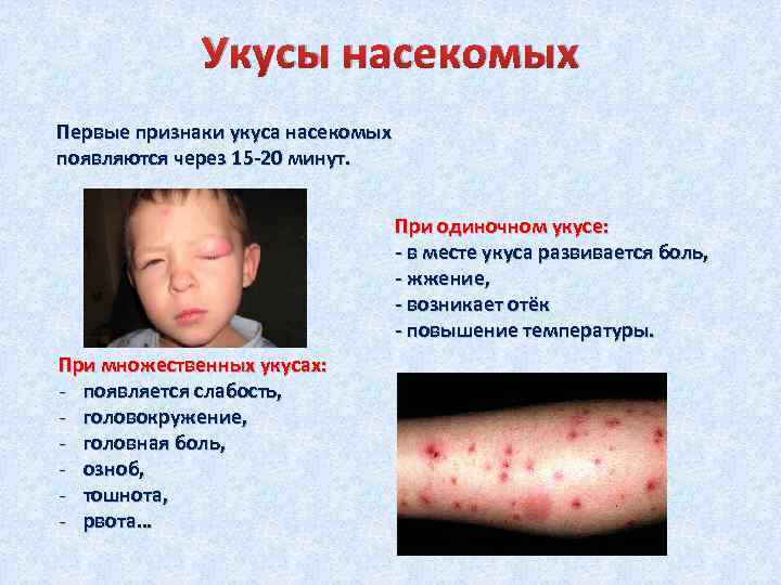 Укусы насекомых Первые признаки укуса насекомых появляются через 15 -20 минут. При одиночном укусе: