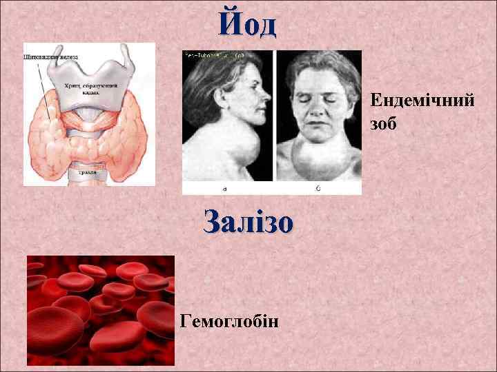 Йод Ендемічний зоб Залізо Гемоглобін 