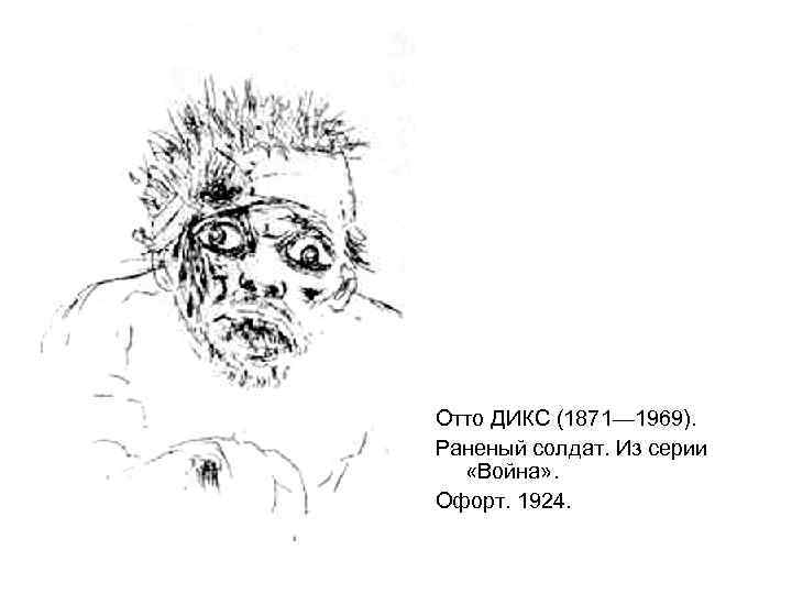 Отто ДИКС (1871— 1969). Раненый солдат. Из серии «Война» . Офорт. 1924. 