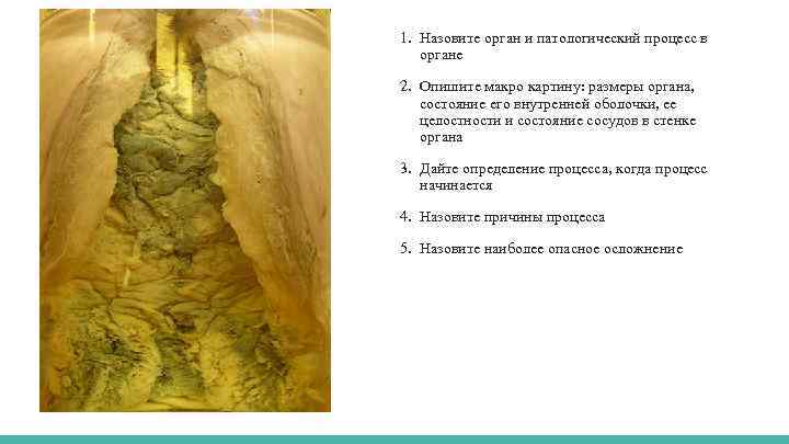 1. Назовите орган и патологический процесс в органе 2. Опишите макро картину: размеры органа,