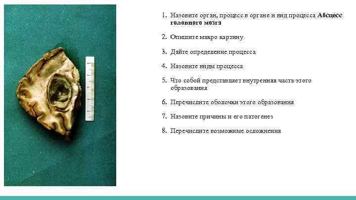 1. Назовите орган, процесс в органе и вид процесса Абсцесс головного мозга 2. Опишите