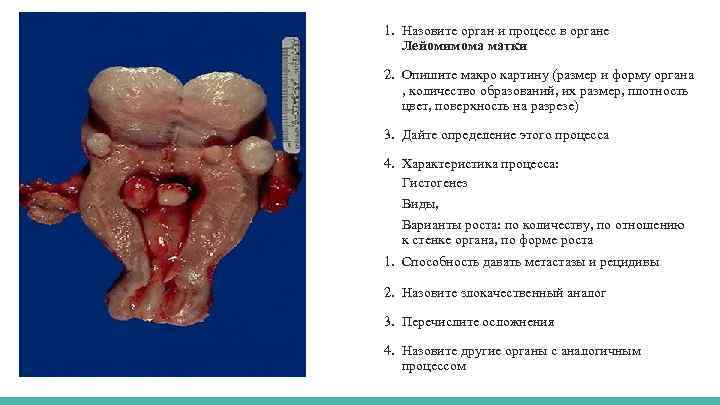 1. Назовите орган и процесс в органе Лейомимома матки 2. Опишите макро картину (размер