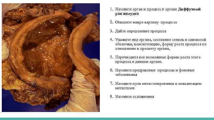 1. Назовите орган и процесс в органе Диффузный рак желудка 2. Опишите макро картину