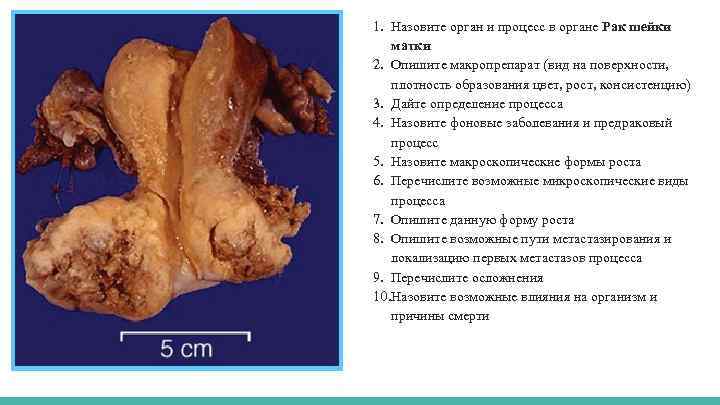 1. Назовите орган и процесс в органе Рак шейки матки 2. Опишите макропрепарат (вид