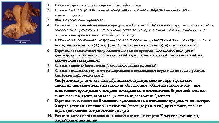 1. 2. Назовите орган и процесс в органе: Рак шейки матки Опишите макропрепарат (вид