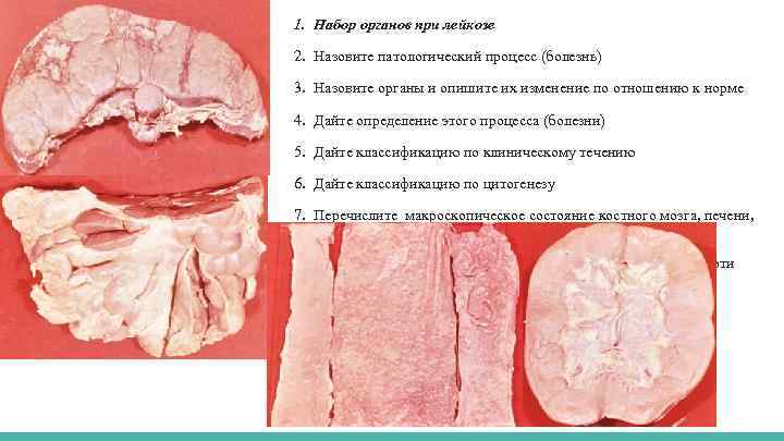 1. Набор органов при лейкозе 2. Назовите патологический процесс (болезнь) 3. Назовите органы и