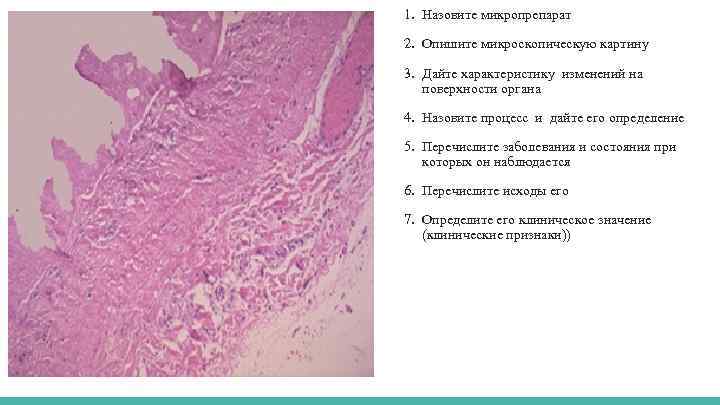 1. Назовите микропрепарат 2. Опишите микроскопическую картину 3. Дайте характеристику изменений на поверхности органа
