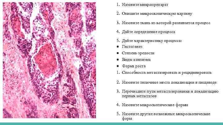 1. Назовите микропрепарат 2. Опишите микроскопическую картину 3. Назовите ткань из которой развивается процесс