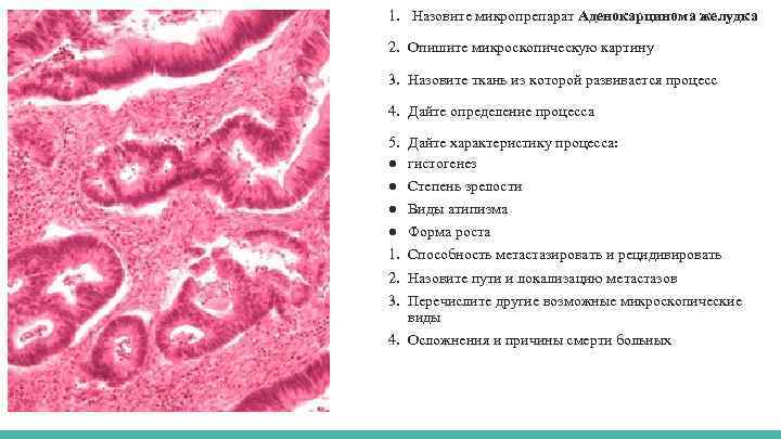 1. Назовите микропрепарат Аденокарцинома желудка 2. Опишите микроскопическую картину 3. Назовите ткань из которой