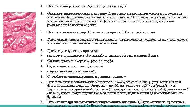 1. Назовите микропрепарат Аденокарцинома желудка 2. Опишите микроскопическую картину Стенку желудка прорастает опухоль, состоящая