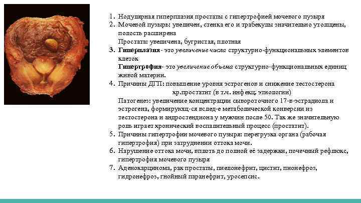 1. Нодулярная гиперплазия простаты с гипертрофией мочевого пузыря 2. Мочевой пузырь: увеличен, стенка его