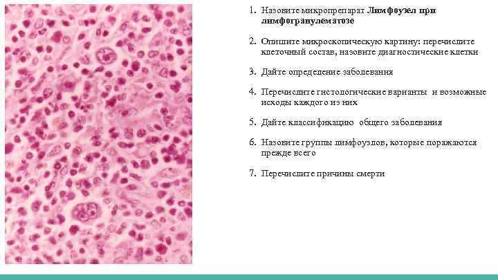 1. Назовите микропрепарат Лимфоузел при лимфогранулематозе 2. Опишите микроскопическую картину: перечислите клеточный состав, назовите