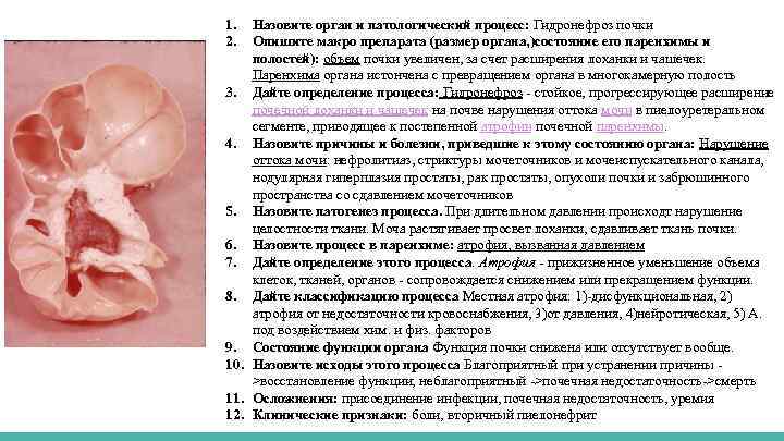 1. 2. Назовите орган и патологический процесс: Гидронефроз почки Опишите макро препарата (размер органа,