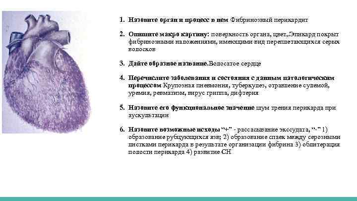 1. Назовите орган и процесс в нем Фибринозный перикардит 2. Опишите макро картину: поверхность