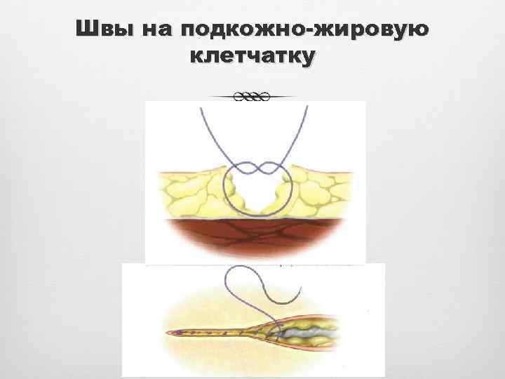 Швы на подкожно-жировую клетчатку 