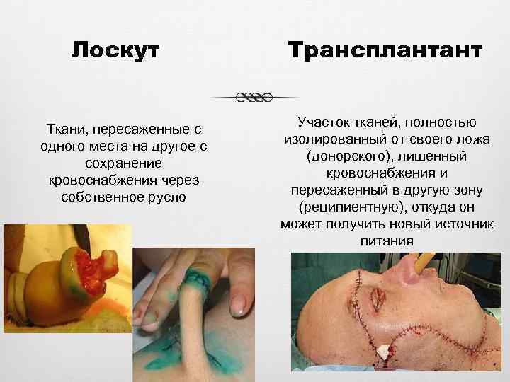 Лоскут Ткани, пересаженные с одного места на другое с сохранение кровоснабжения через собственное русло