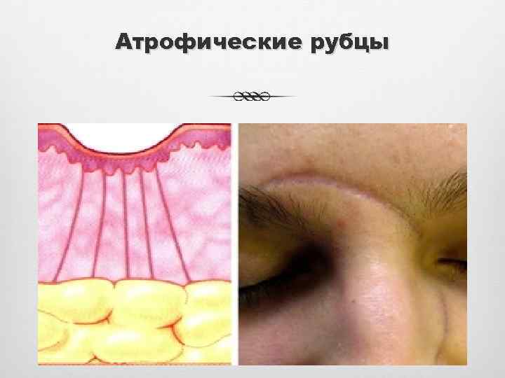 Атрофические рубцы 
