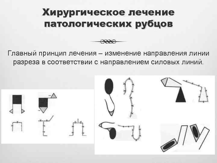 Хирургическое лечение патологических рубцов Главный принцип лечения – изменение направления линии разреза в соответствии