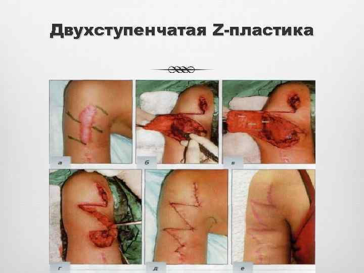 Двухступенчатая Z-пластика 