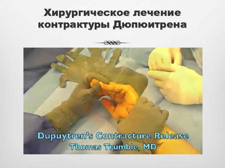 Хирургическое лечение контрактуры Дюпюитрена 