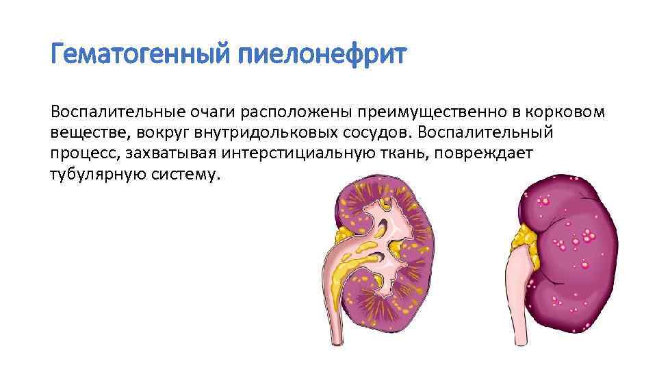 Гематогенный пиелонефрит Воспалительные очаги расположены преимущественно в корковом веществе, вокруг внутридольковых сосудов. Воспалительный процесс,