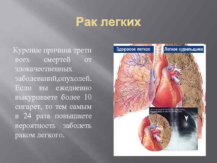 Рак легких Курение причина трети всех смертей от злокачественных заболеваний, опухолей. Если вы ежедневно