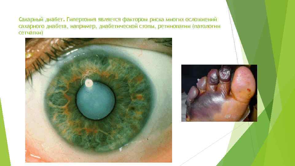 Сахарный диабет. Гипертония является фактором риска многих осложнений сахарного диабета, например, диабетической стопы, ретинопатии