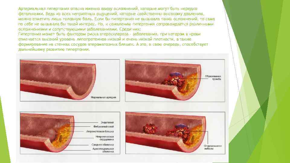 Артериальная гипертония опасна именно ввиду осложнений, которые могут быть нередко фатальными. Ведь из всех