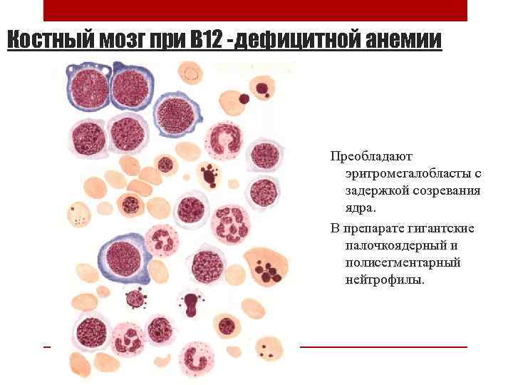Костный мозг при В 12 -дефицитной анемии Преобладают эритромегалобласты с задержкой созревания ядра. В