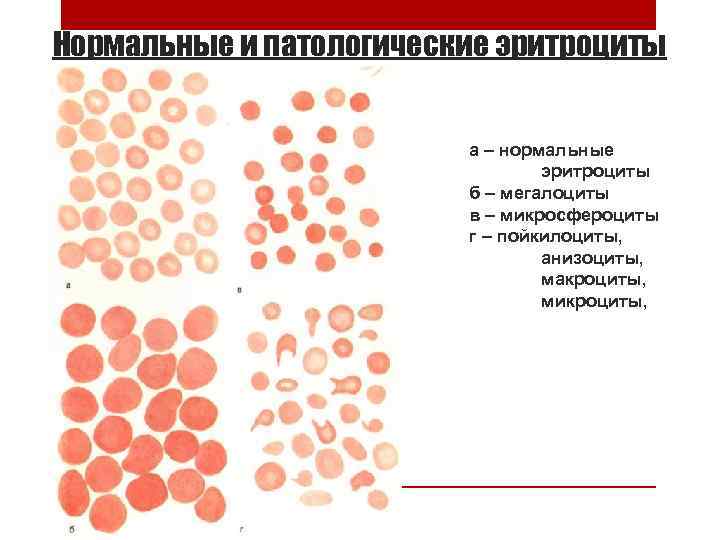 Нормальные и патологические эритроциты а – нормальные эритроциты б – мегалоциты в – микросфероциты