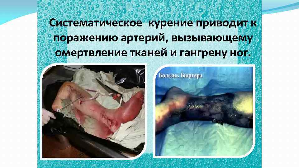 Систематическое курение приводит к поражению артерий, вызывающему омертвление тканей и гангрену ног. 