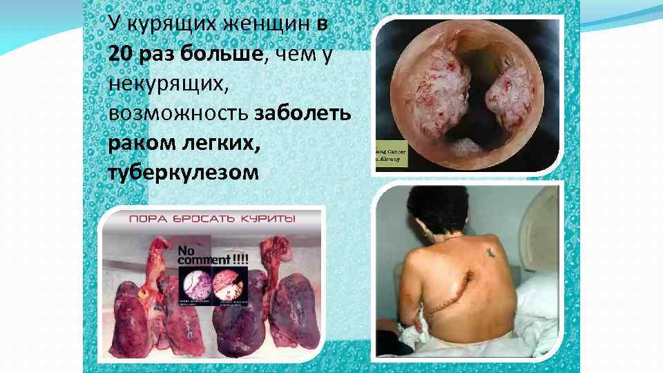 У курящих женщин в 20 раз больше, чем у некурящих, возможность заболеть раком легких,