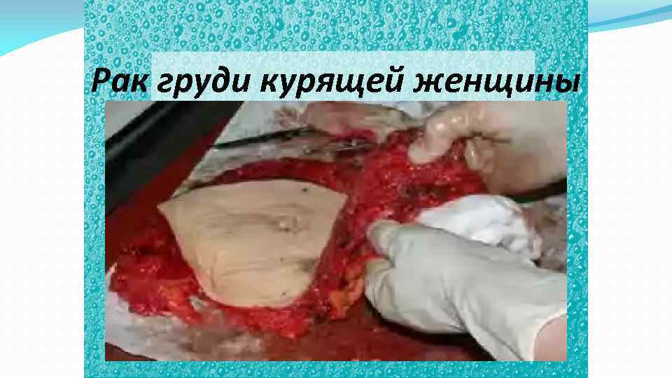 Рак груди курящей женщины 